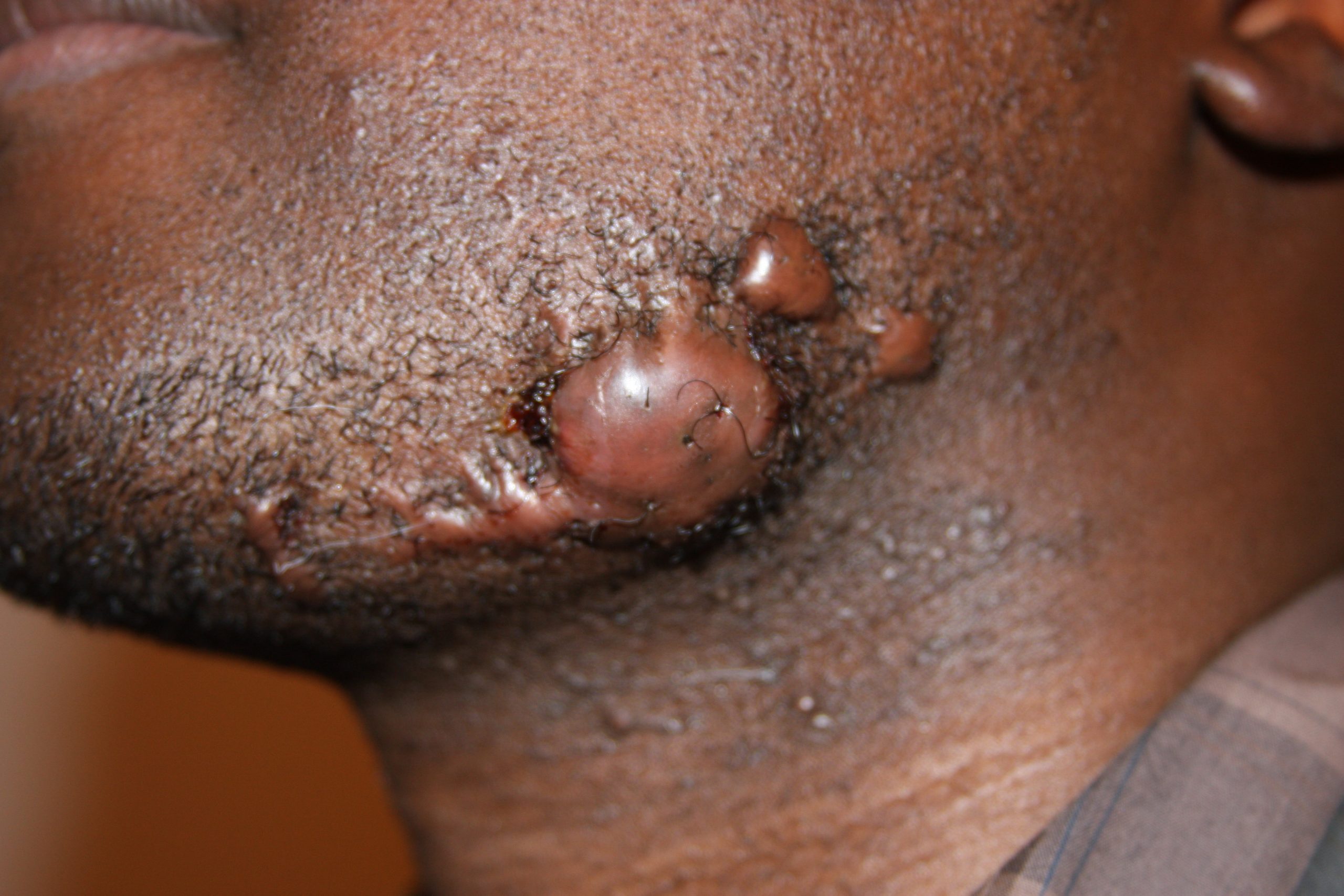 Facial Keloids - Recurrence after surgery Facial Keloids - Recurrence after surgery