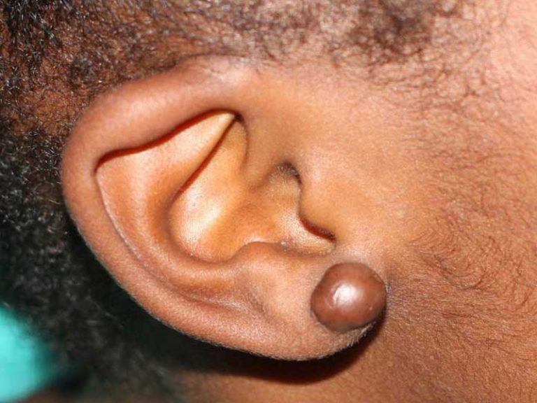 Earlobe Keloids in Children