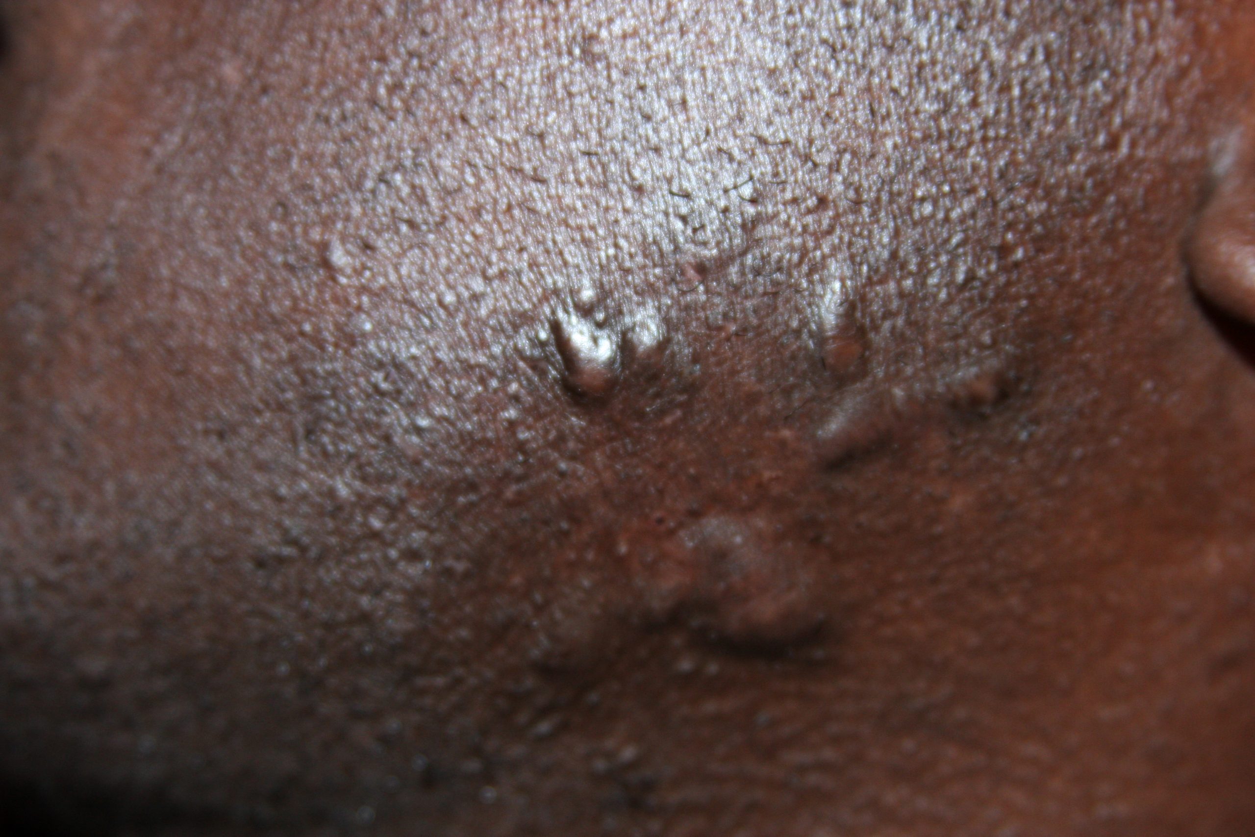 Face Keloids Face Keloids