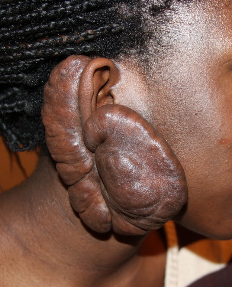 Massive Ear Keloid