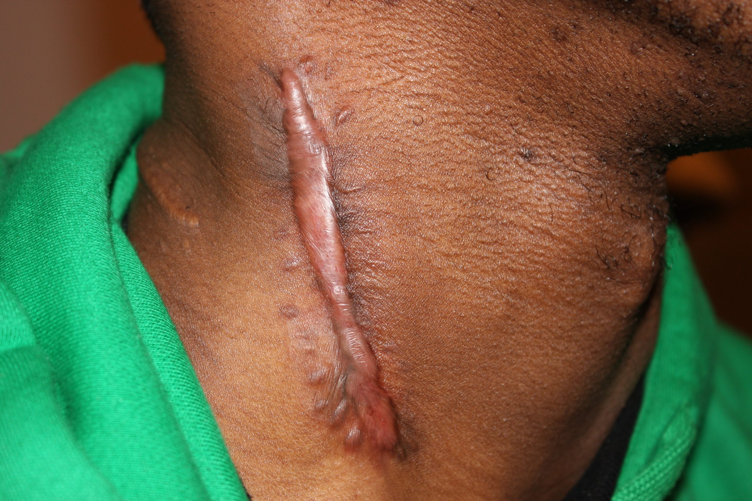 Vertical Neck Keloid