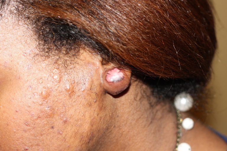 Massive Ear Keloid Treated with Cryotherapy