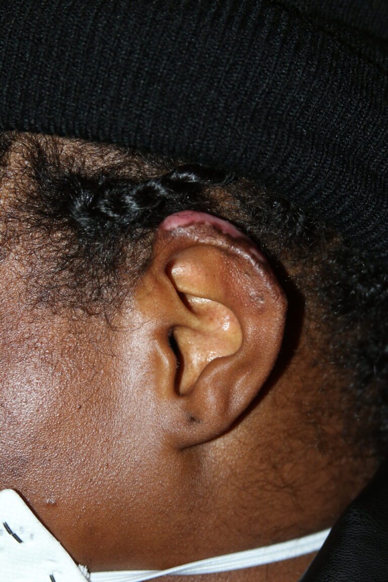 Massive Ear Keloid Treated with Cryotherapy Massive Ear Keloid Treated with Cryotherapy
