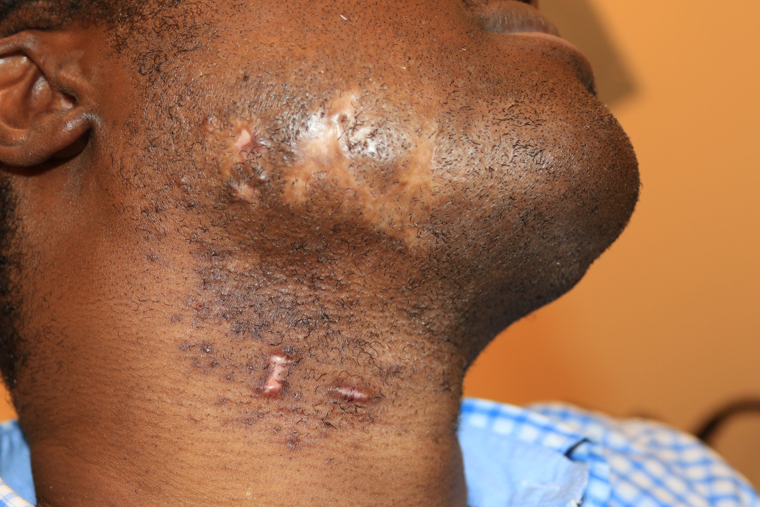 Face Keloid - Treatment outcome