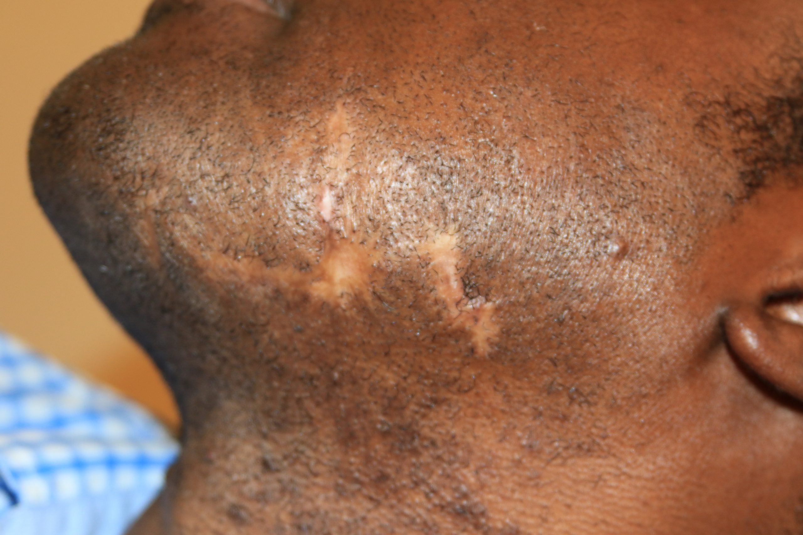 Face Keloid - Treatment outcome