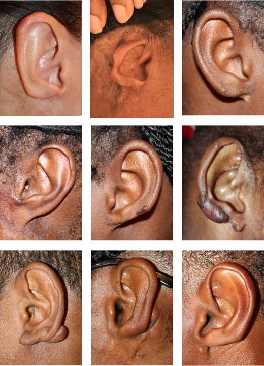 Loss of Ear/Earlobe to Keloid Removal Surgery Loss of Ear/Earlobe to Keloid Removal Surgery