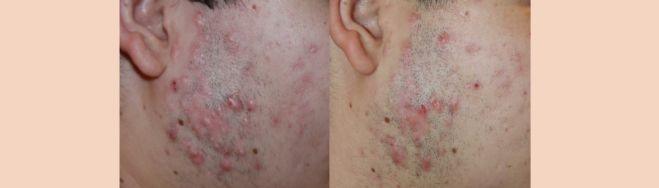 Facial Keloid Treatment of Face Keloid Keloid Specialist NY