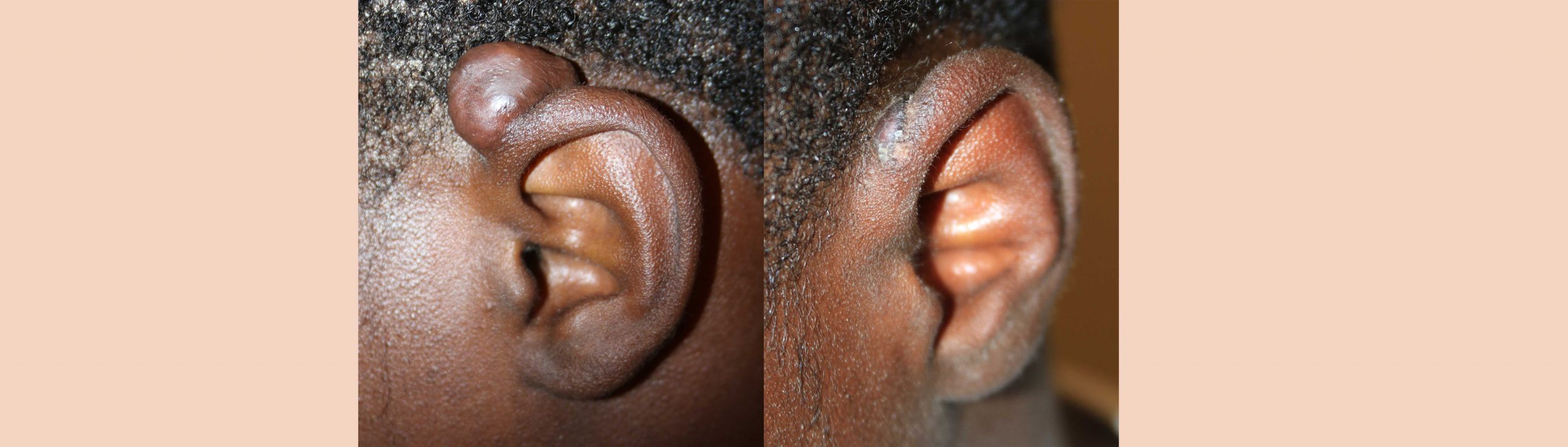 Keloid on ear, Earlobe Keloid Treatment Non surgical