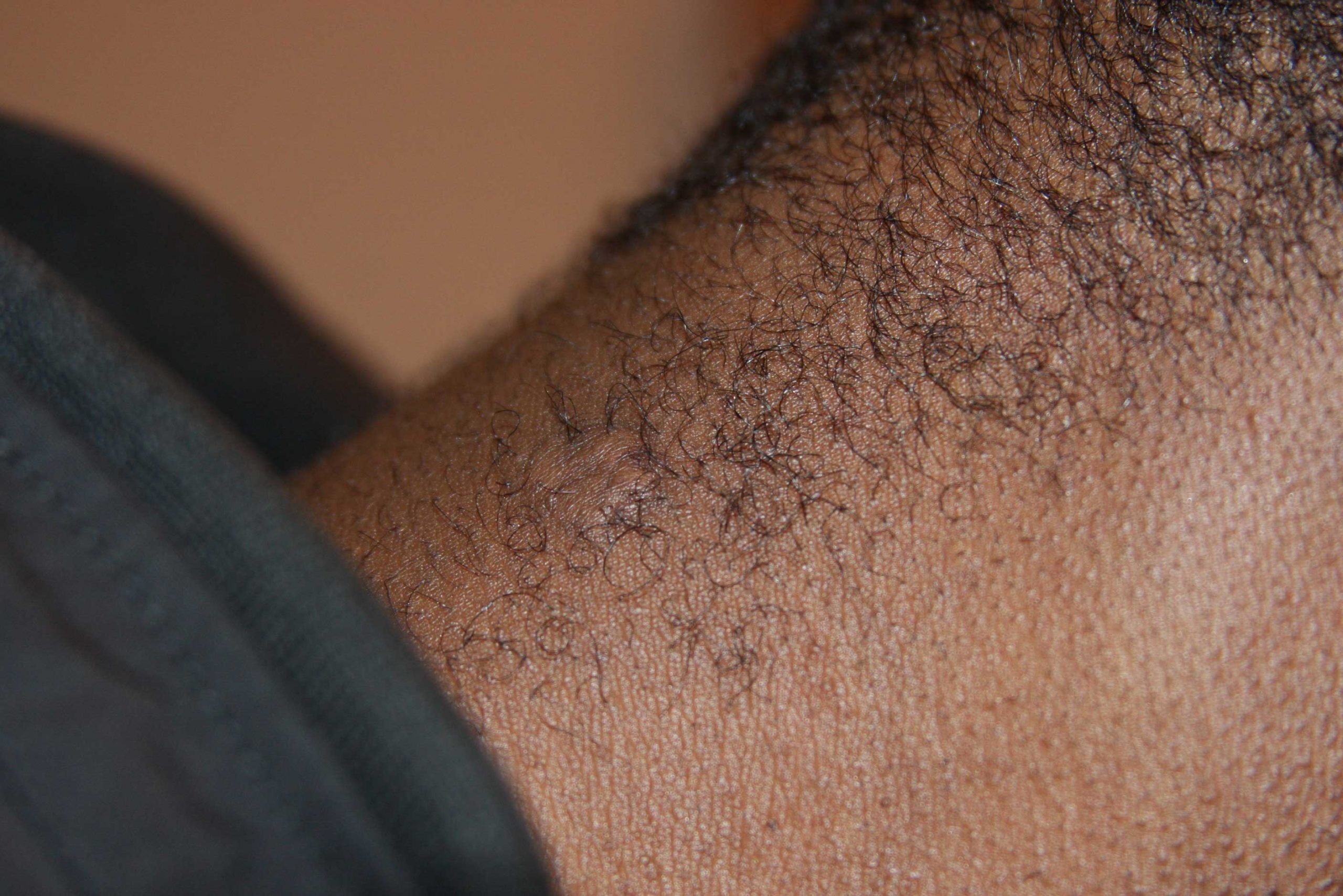 Neck Keloid - Durable treatment outcome after only one cycle of cryotherapy