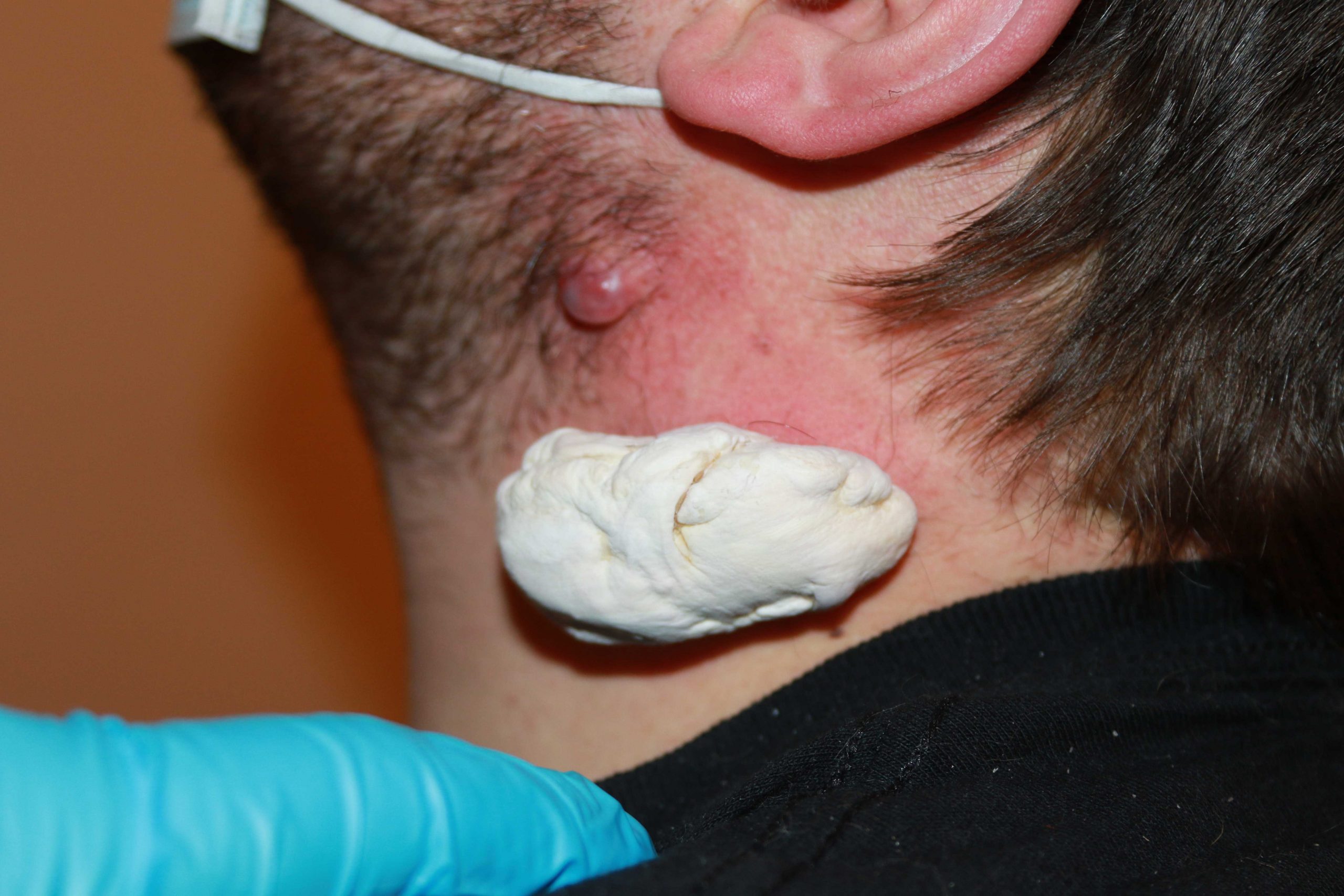 Neck Keloid - Immediately after application of cryotherapy