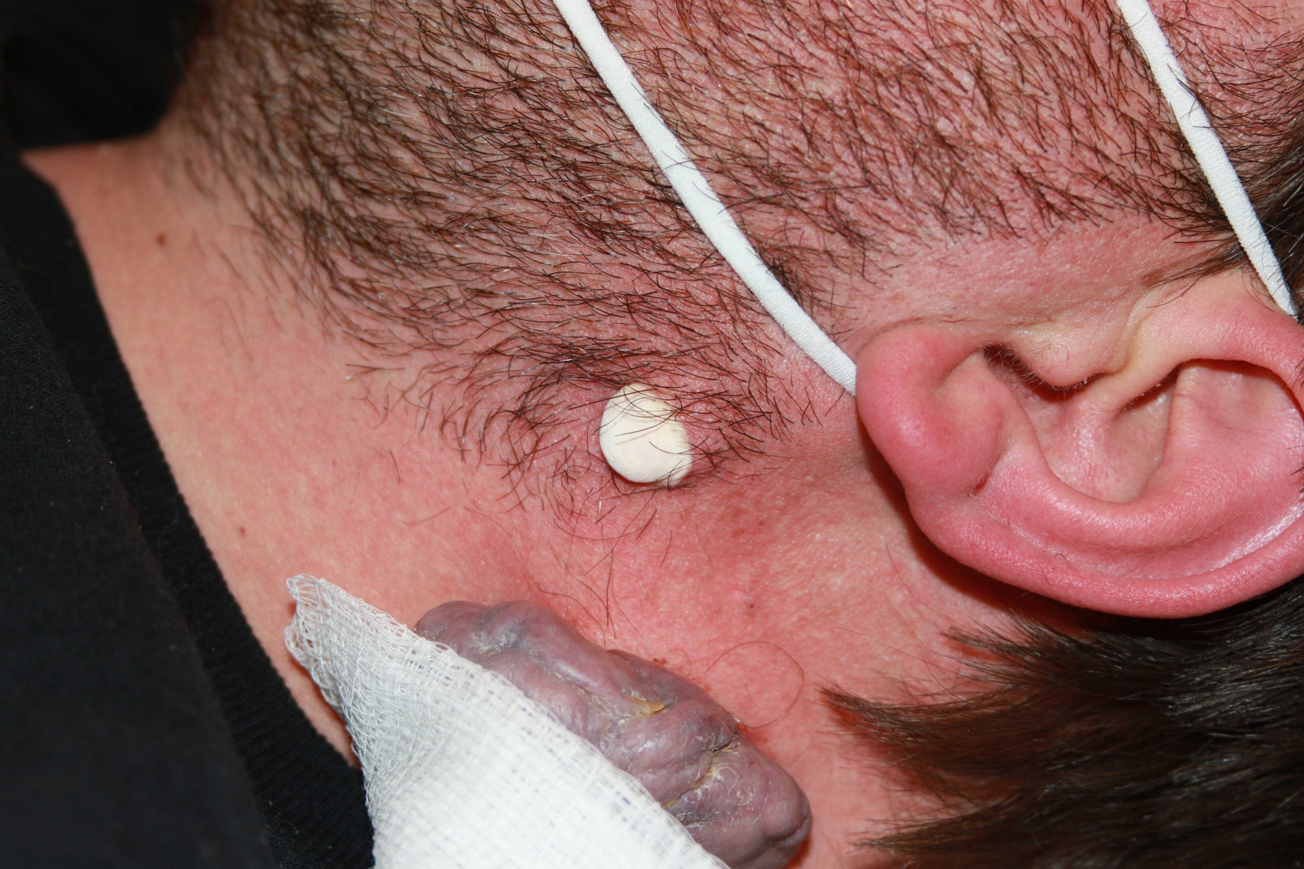 Neck Keloid - Immediately after application of cryotherapy