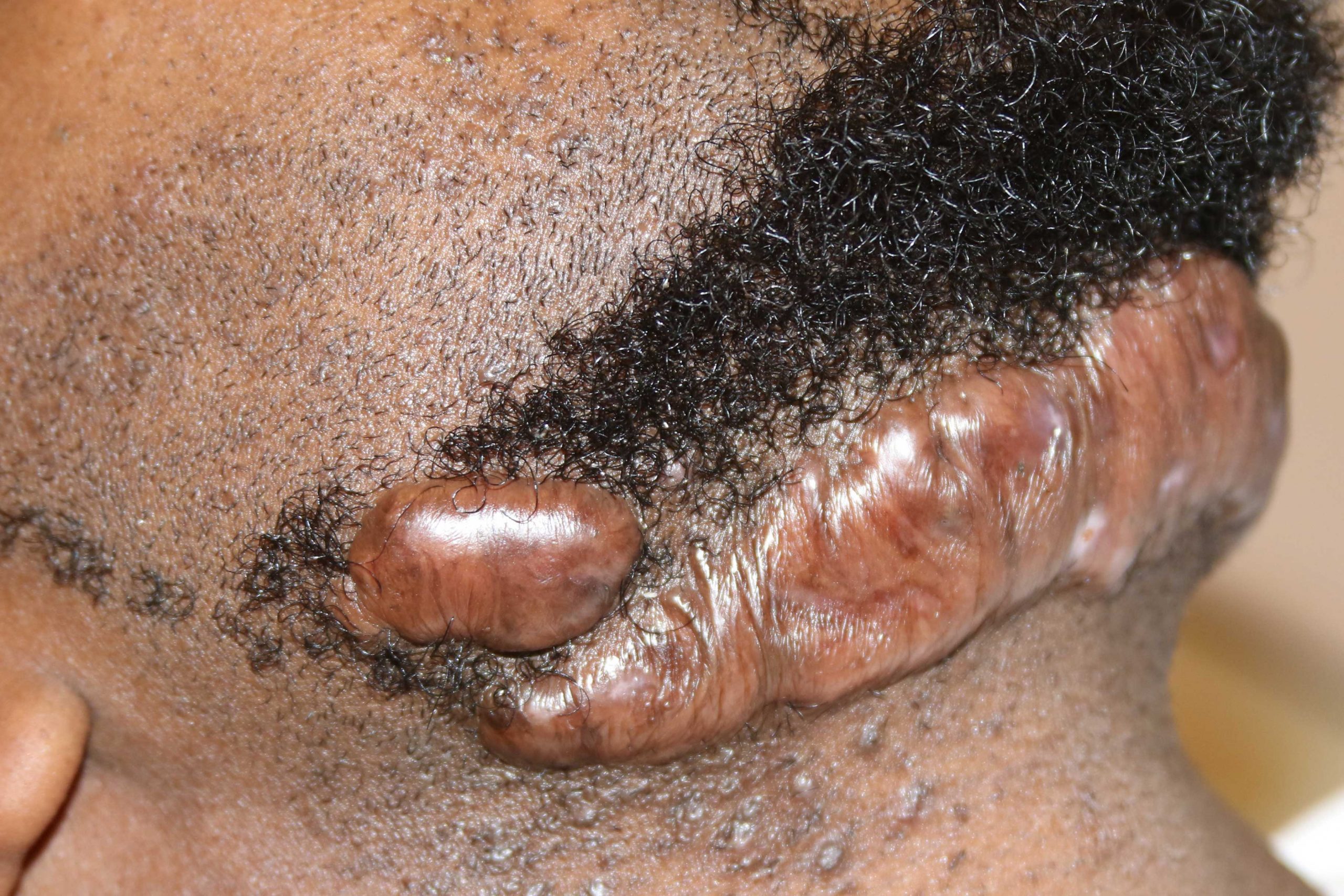 Semi massive neck keloid