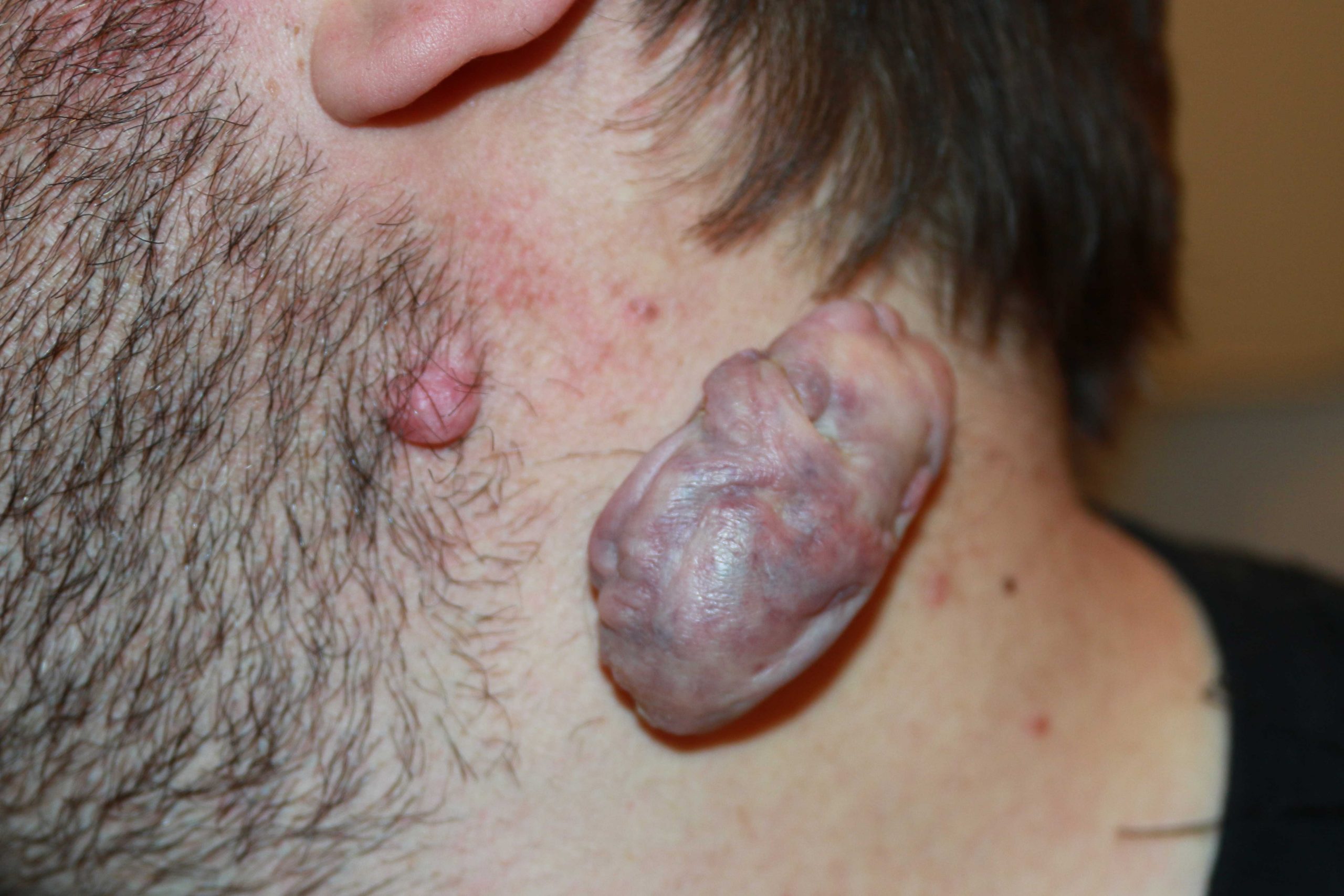 Large tumoral Neck Keloid