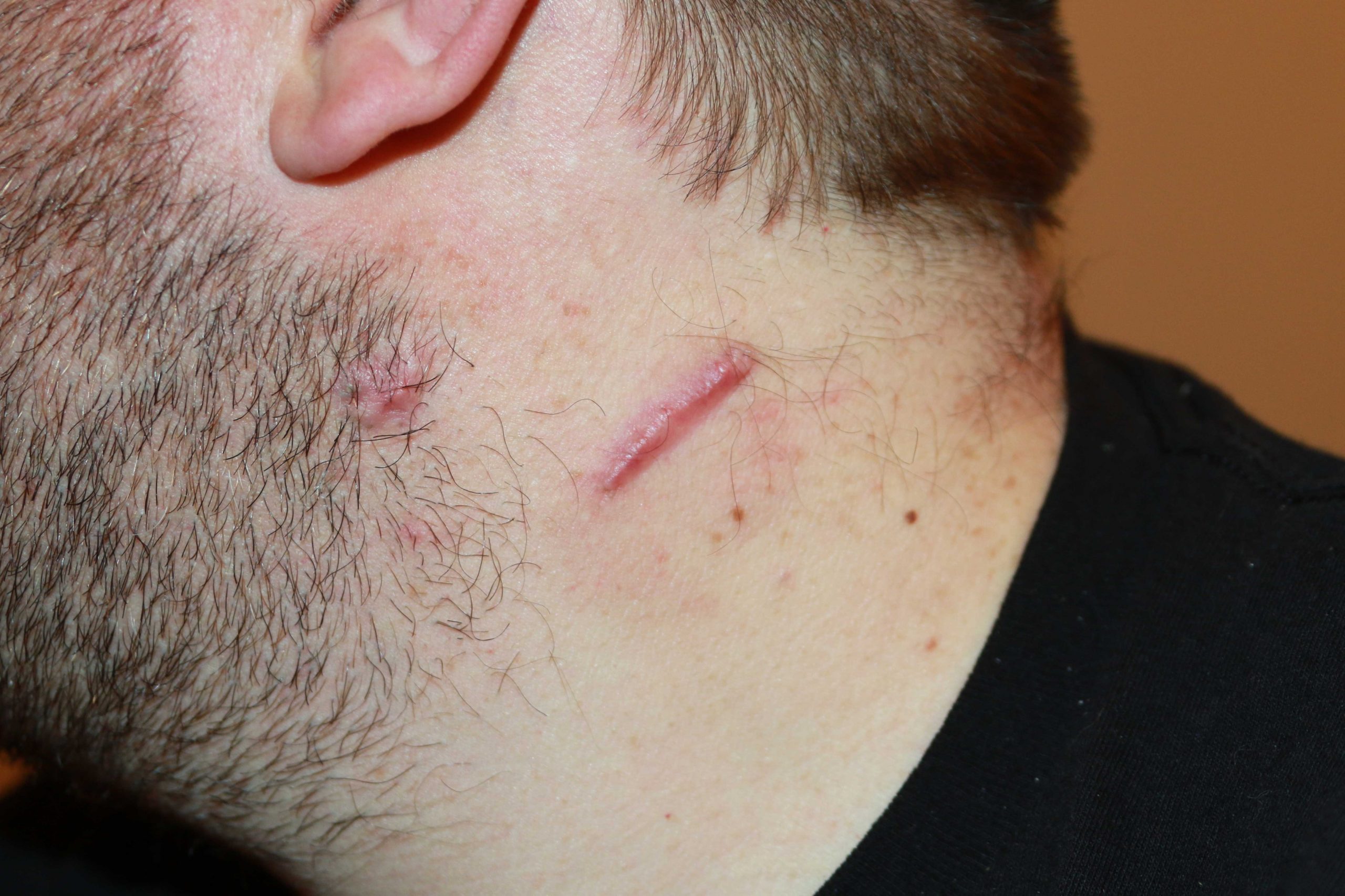Neck Keloid - 4 months after cryotherapy Neck Keloid - 4 months after cryotherapy