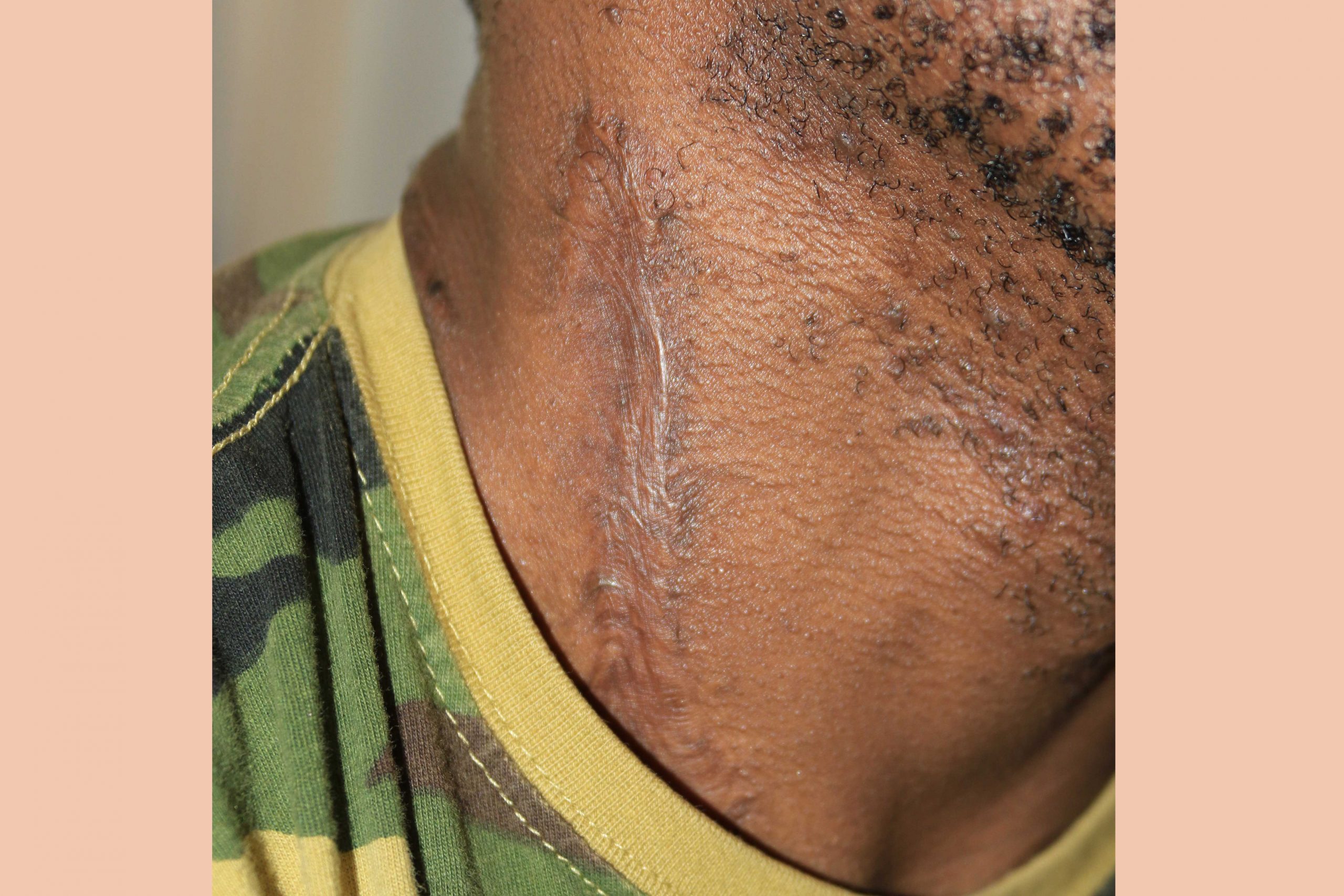 Neck Keloid - long-term treatment outcome