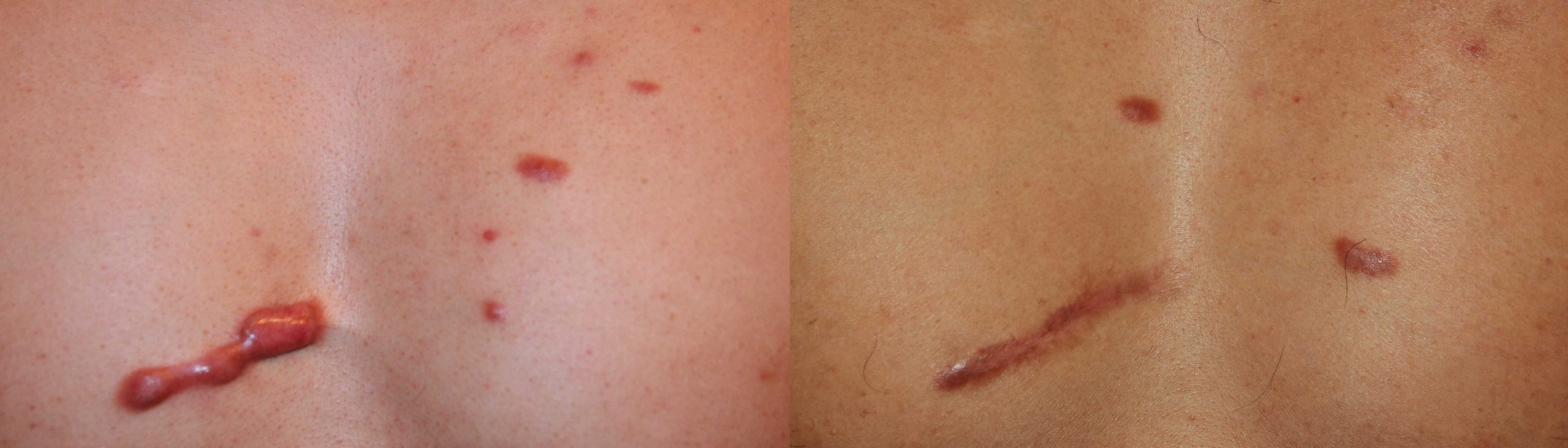 Chest keloids Treated with chemotherapy