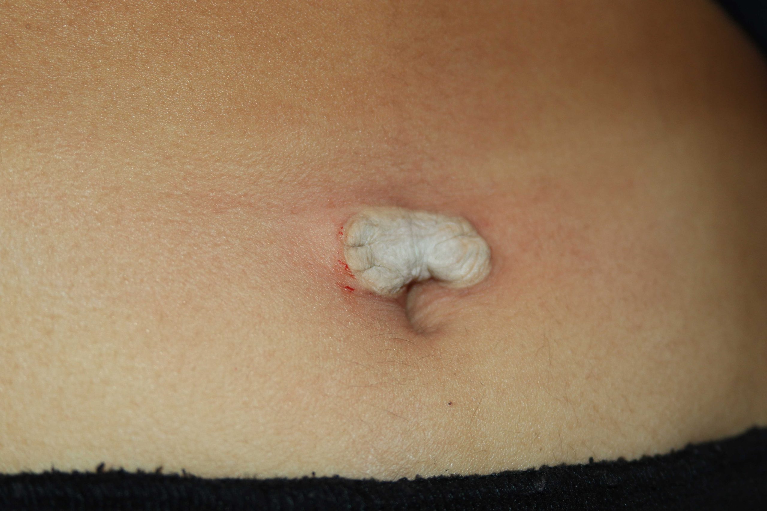 Umbilical (belly button) keloid - Immediately after the application of cryotherapy. 