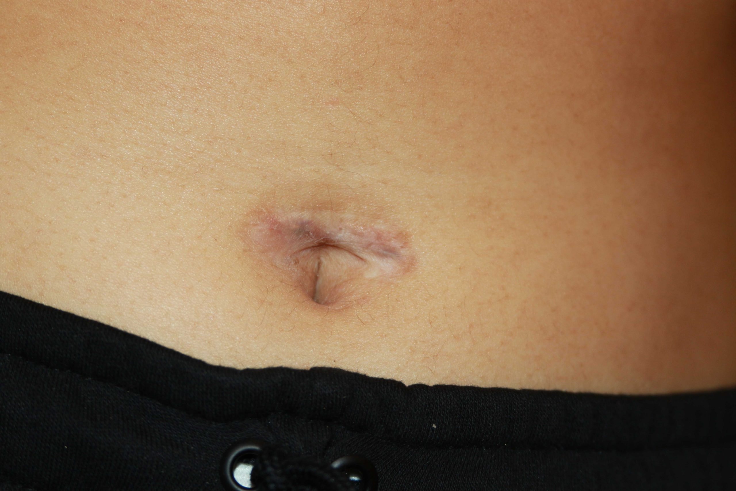 Umbilical (belly button) keloid - One year after first cryotherapy. 