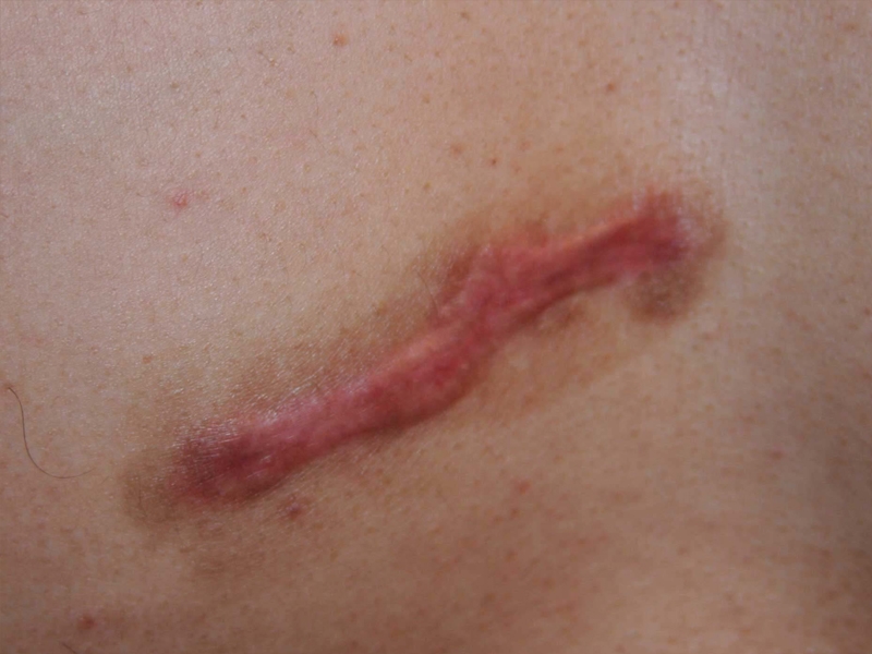 Chest Keloid