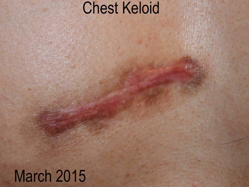 Chest Keloid