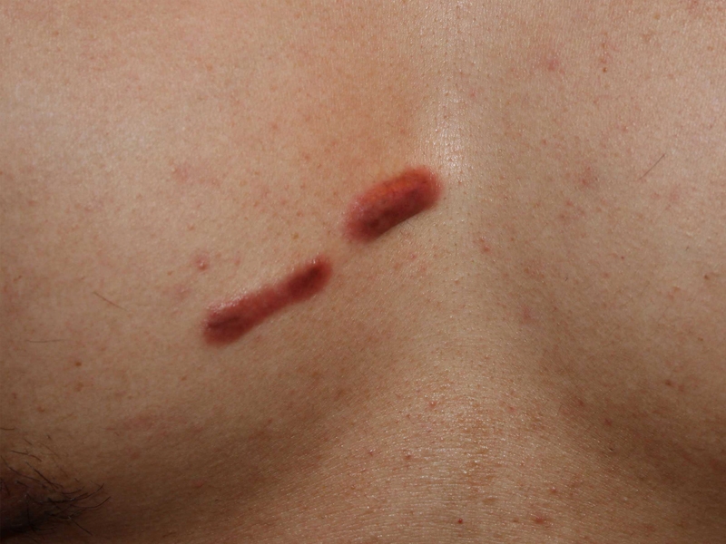 chest keloid