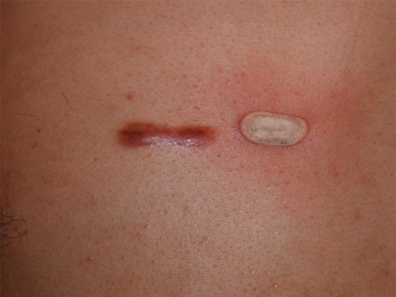 chest keloid