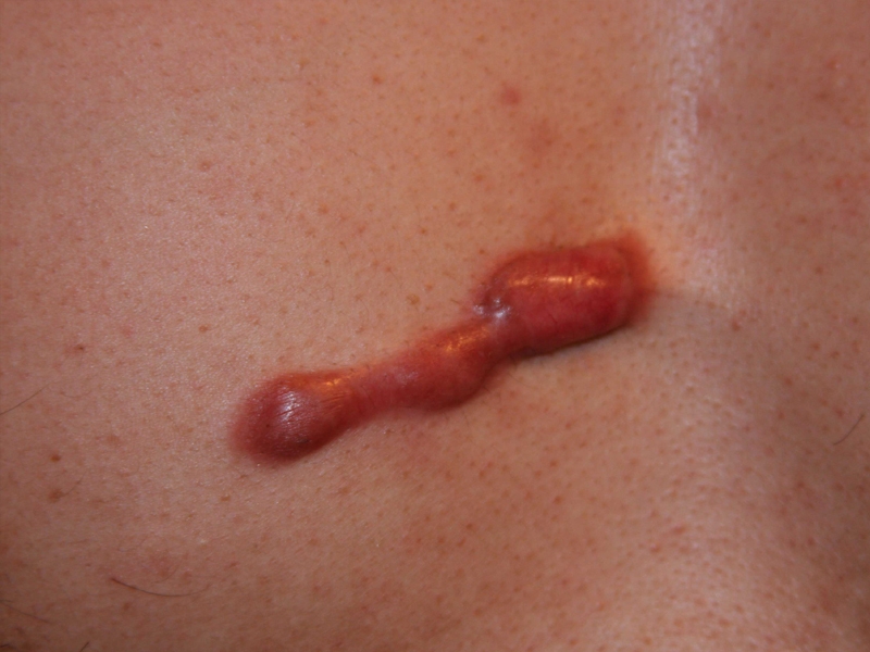 Challenging chest keloid treated with chemotherapy