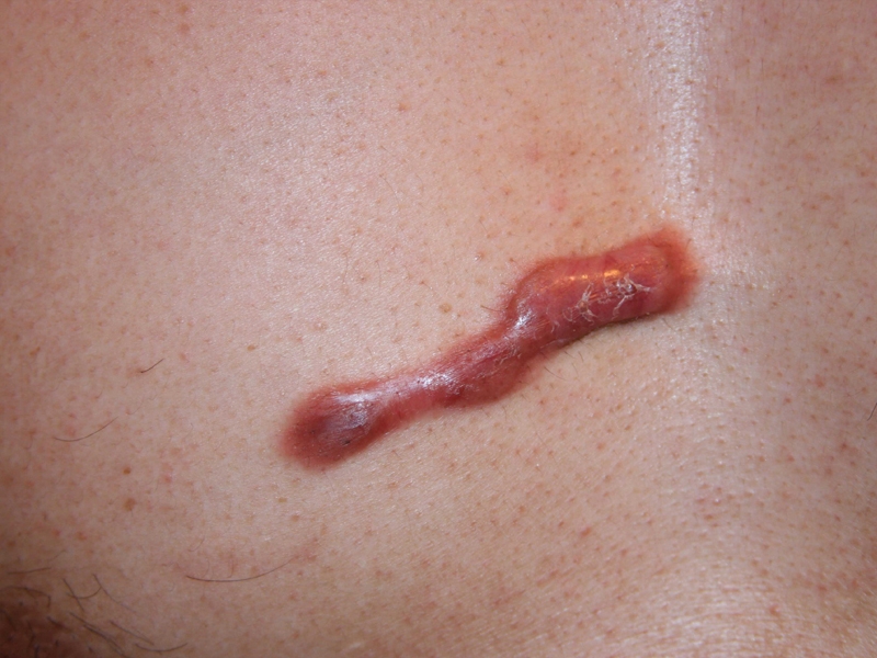 chest keloid