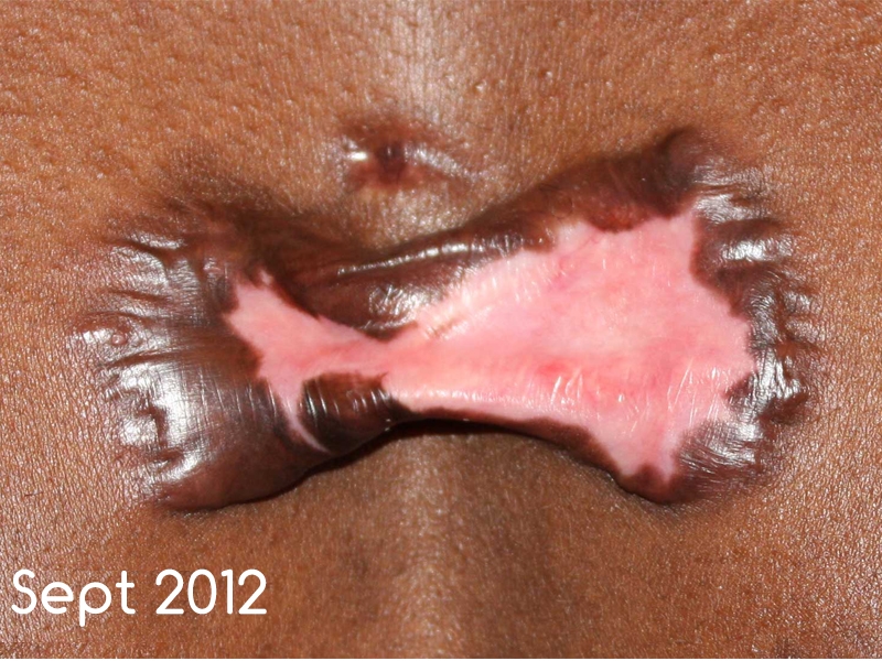 Butterfly Chest Keloids