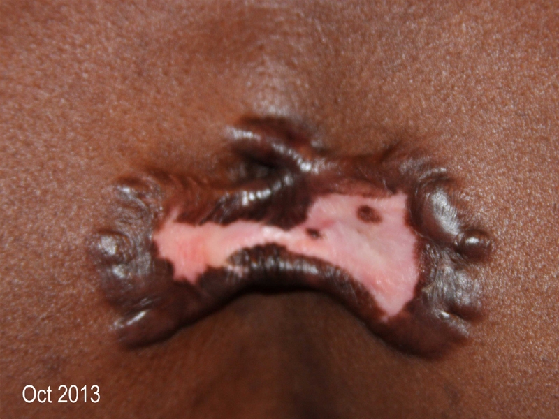 Butterfly Chest Keloids