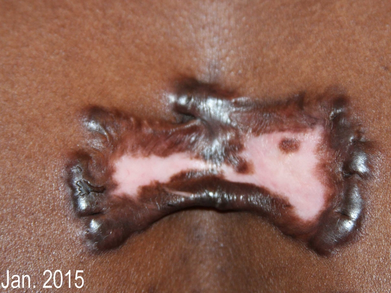 Butterfly Chest Keloids