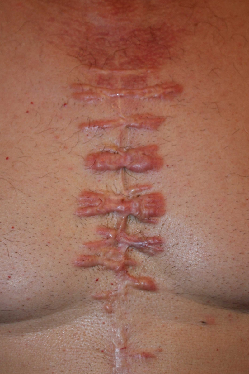 Post-operative chest wall keloids in a middle aged Caucasian male