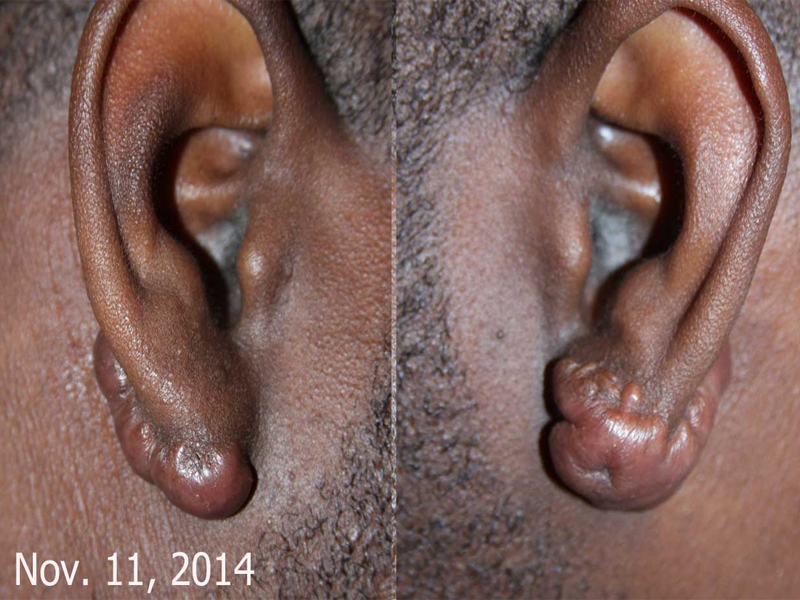 Challenging ear keloids