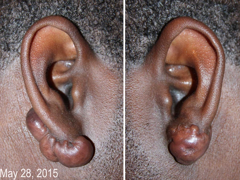 Challenging ear keloids