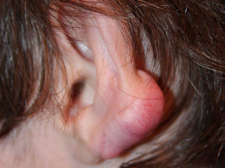Recurrent Ear Keloid Recurrent Ear Keloid