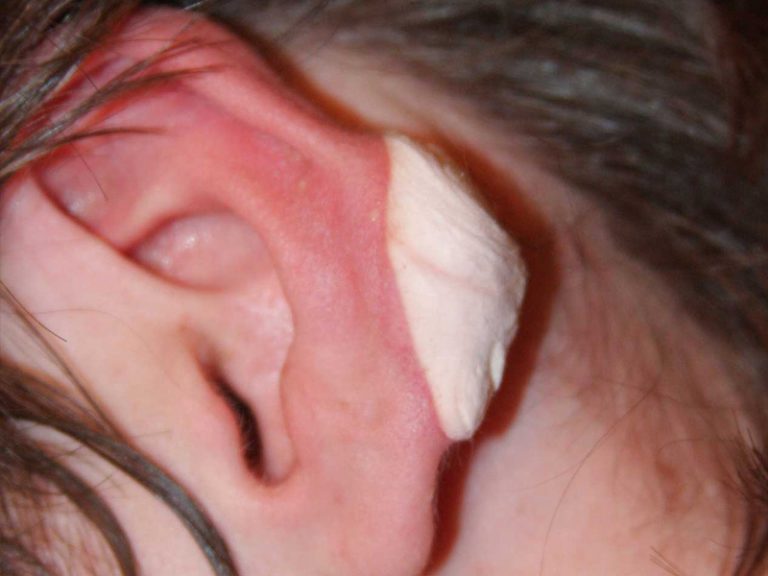 Ear Keloid immediately after application of cryotherapy.