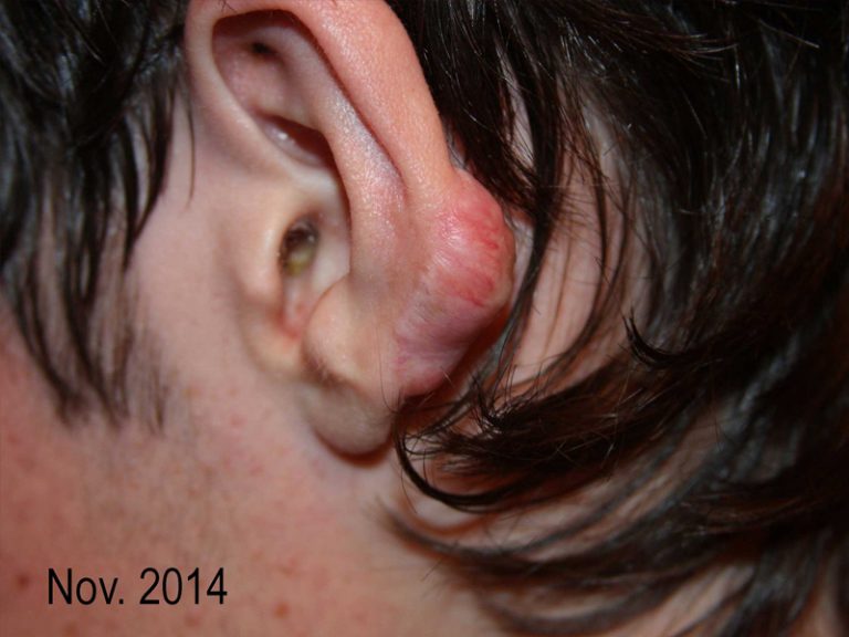 Ear Keloid in a 15-year-old