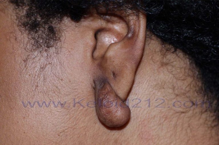 Earlobe Keloid - previously untreated 