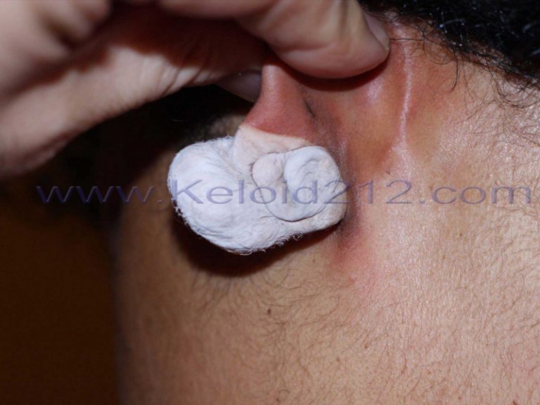 Cryotherapy for treatment of earlobe keloid.