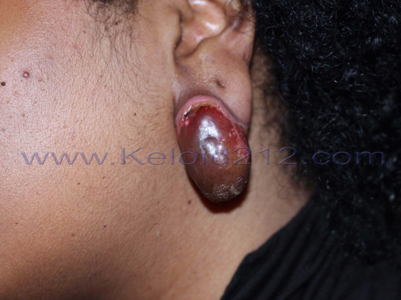 Blistering of keloid after cryotherapy