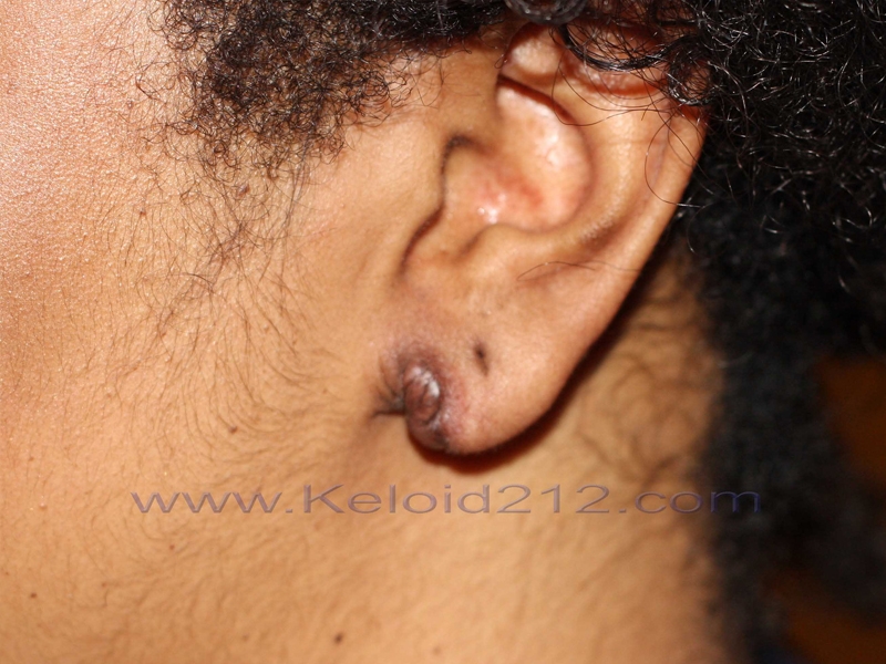 Earlobe Keloid - Treatment outcome after one course of cryotherapy