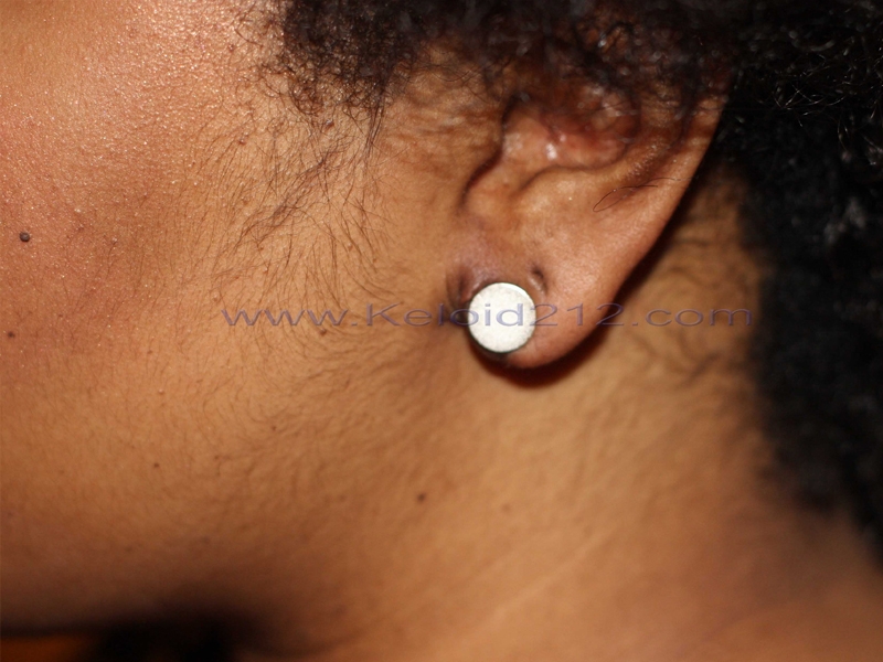 Earlobe Keloid - Application of magnetic discs to the earlobe.