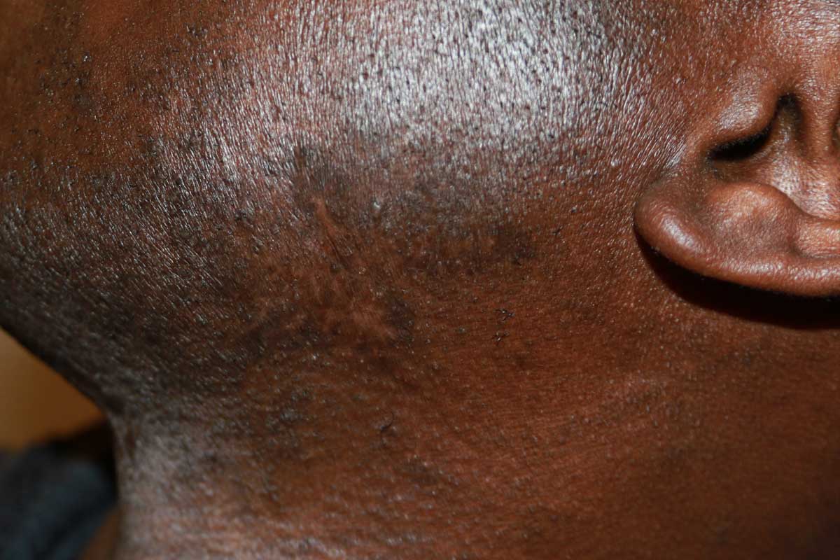 Face Keloid - Treatment outcome