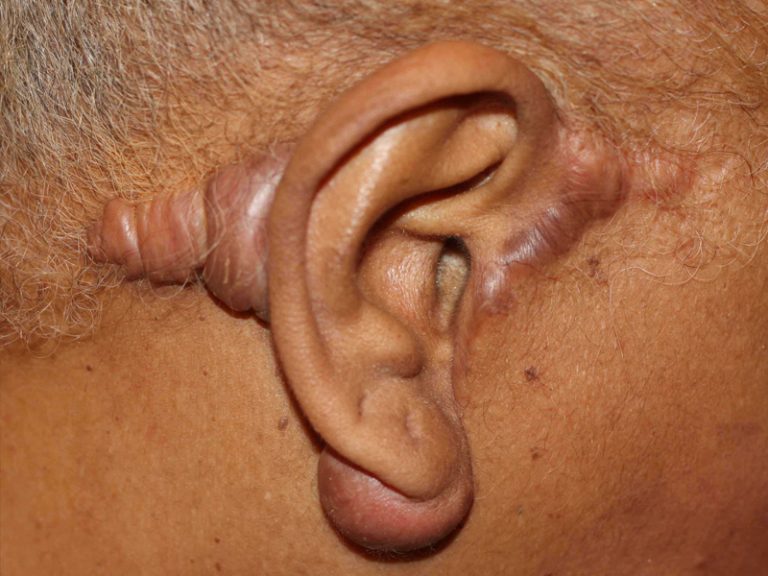 Facelift Surgery and Keloid Formation Aesthetic Surgery and Keloid Formation