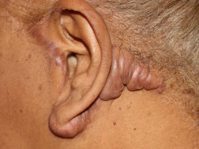 Facelift Surgery and Keloid Formation