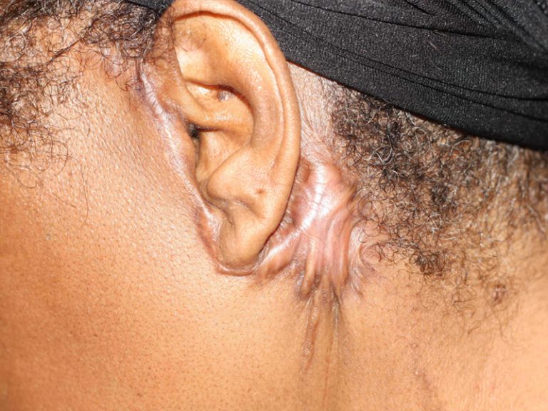 FaceliftSurgery and Keloid Formation Aesthetic Surgery and Keloid Formation