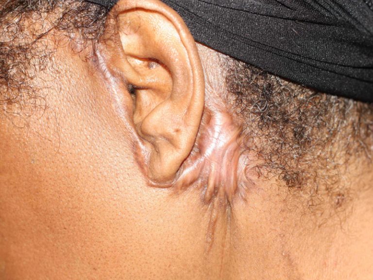 Aesthetic Surgery and Keloid Formation