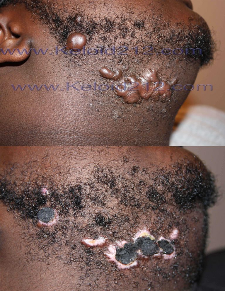 Facial and Neck Keloids