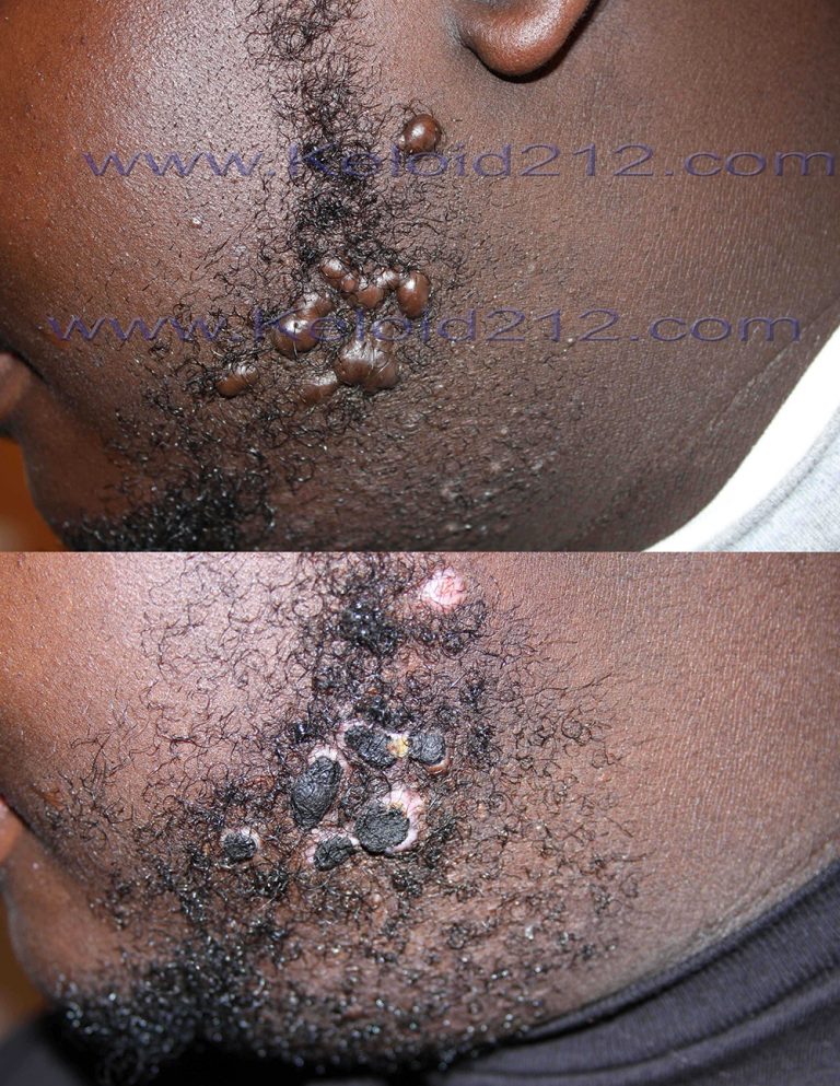 Facial and Neck Keloids