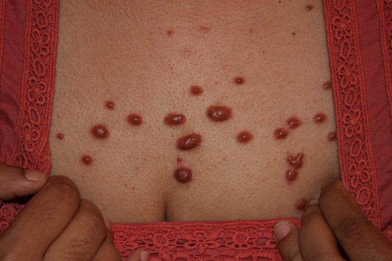 Guttate Keloids